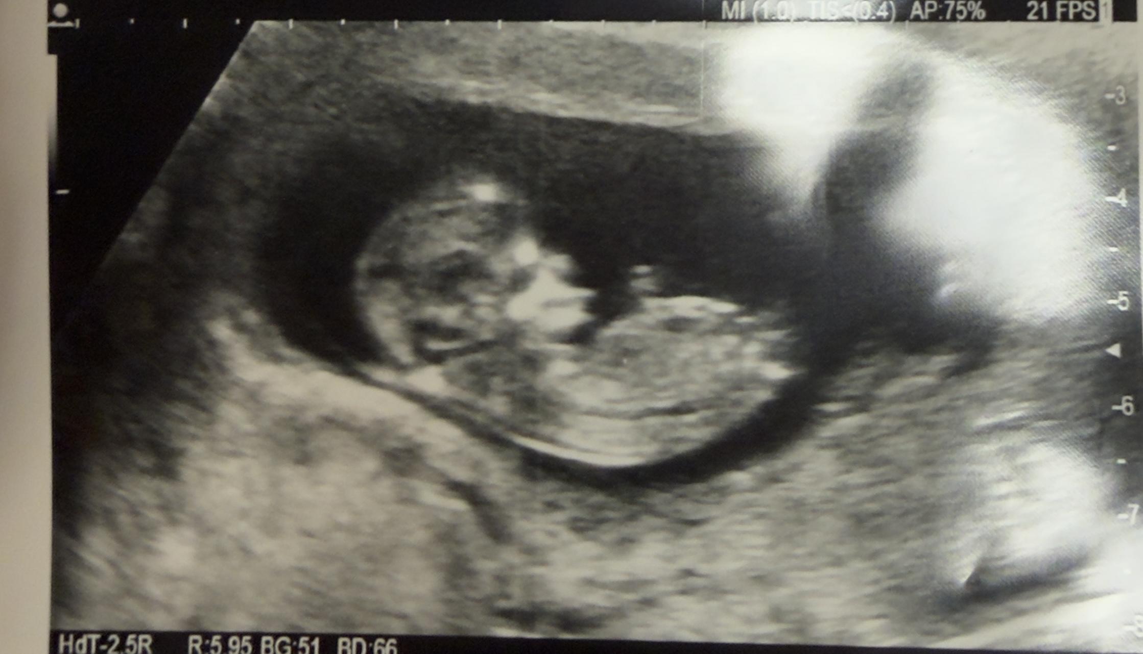 Grainy black-and-white ultrasound scan showing a side profile of a foetus curled in the womb. The small head, nose and torso are visible, with the body resting along the curved edge of the uterus. Measurement markings and scan data appear along the image borders.